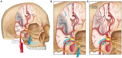 Stimulating the Facial Nerve to Treat Ischemic Stroke: A Systematic Review